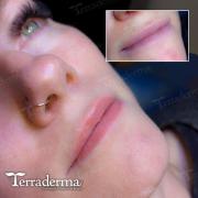 Nanaimo permanent lip blush - Terraderma 2024